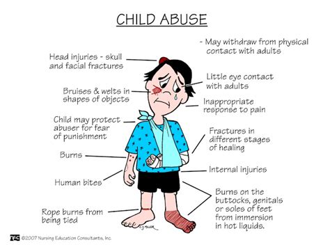 It occurs when a person close to the child deliberately commits an act that results in a physical injury to the child. . Which of the following would not be considered physical abuse